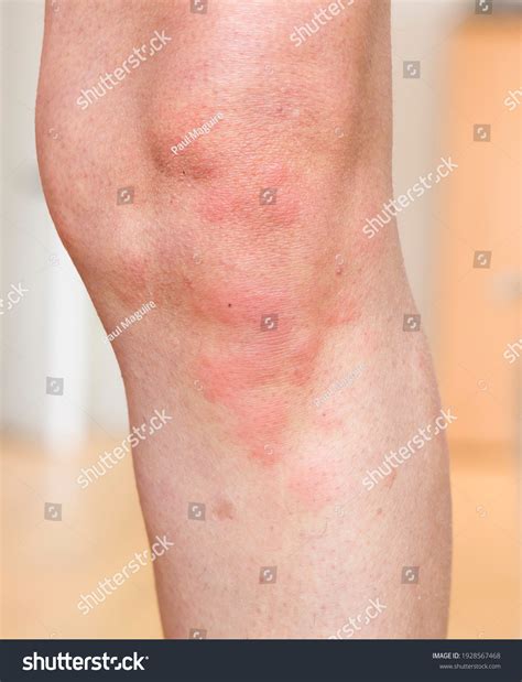 Hives Urticaria Skin Condition Red Skin Stock Photo 1928567468