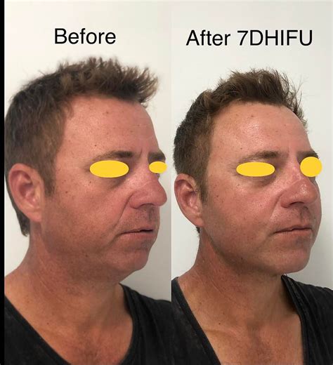advantages   hifu face lifting treatment