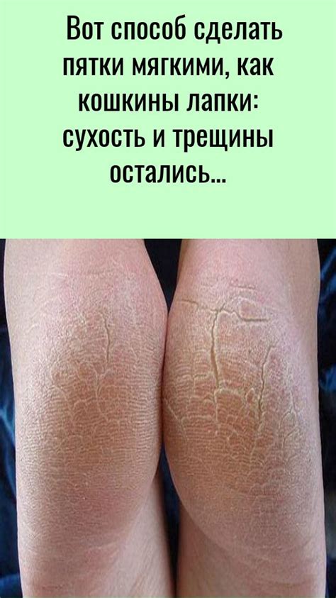 Вот способ сделать пятки мягкими, как кошкины лапки: сухость и трещины ...