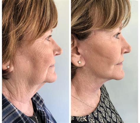 Face & Neck Lift | Ozark Facial Plastic Surgery & Aesthetics