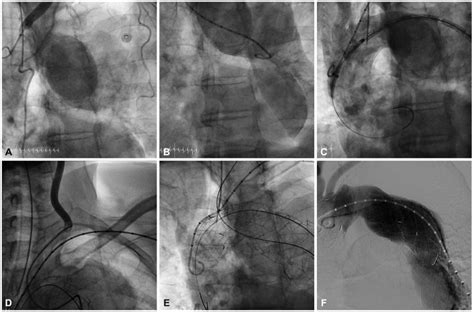 The overall procedure of the patient. A and B: the aortogram before ...