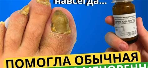 Как избавиться от грибка ногтей на ногах: эффективные методы и советы