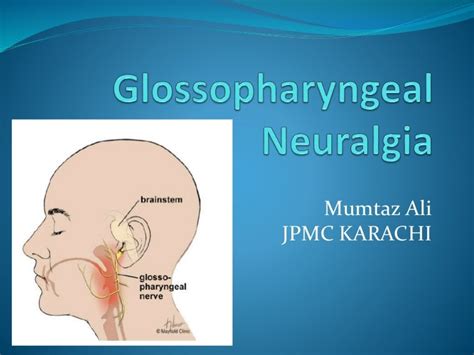 Glossopharyngeal neuralgia presentation