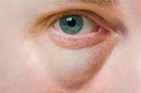 Causes Of Swollen Puffy Under Eyes - Infoupdate.org