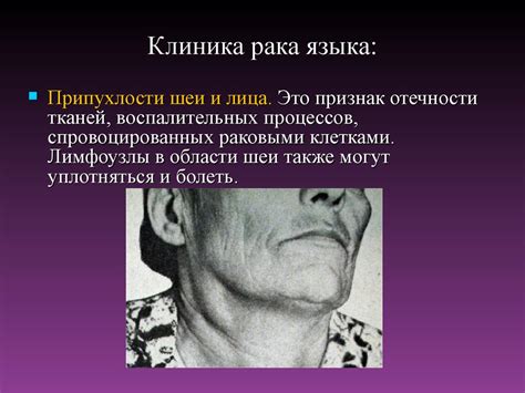 Рак языка - презентация онлайн