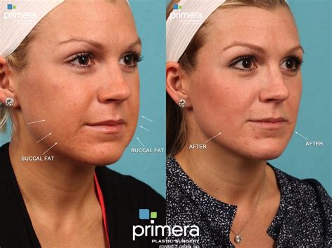 Face Liposuction Before And After