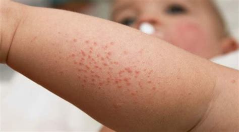 How To Get Rid Of Hives On Your Face / Get Rid Of Hives : Eventually ...