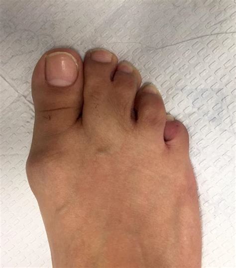 Webbed Toes (Syndactyly)