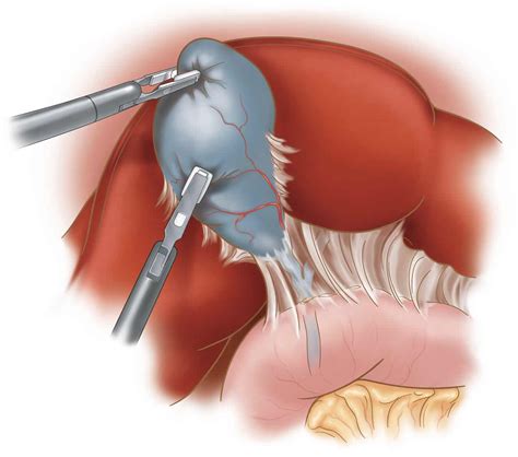 Laparoscopic Cholecystectomy | MD. Yiannis Sioulas, General Surgeon ...