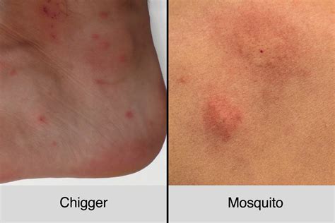 Chigger Bites Vs. Mosquito Bites: How to Tell the Difference | The Healthy