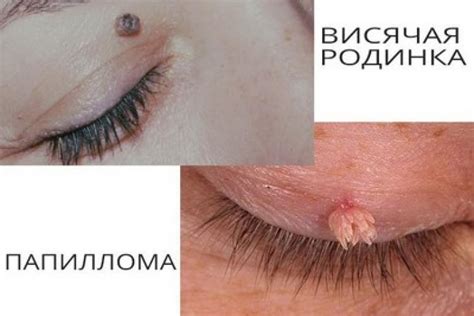 Как отличить родинку от папилломы - Венерические заболевания