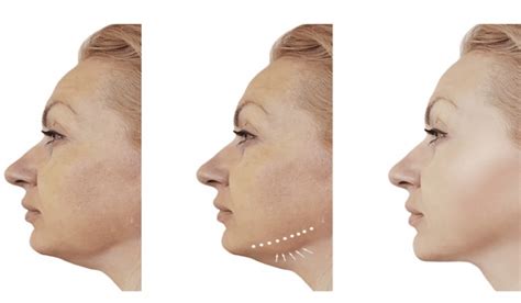 HIFU Machine For Double Chin - VIVA Concept Technology
