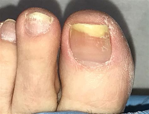 how to fix curly toes
