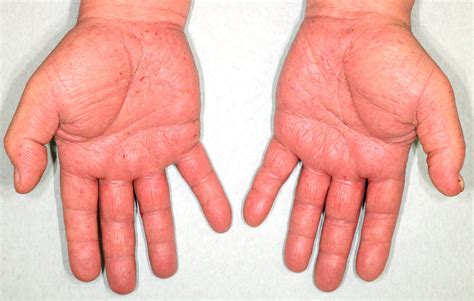 Contact Dermatitis Palms