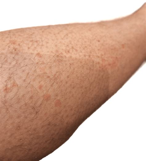 Red spots all over lower legs : r/DermatologyQuestions