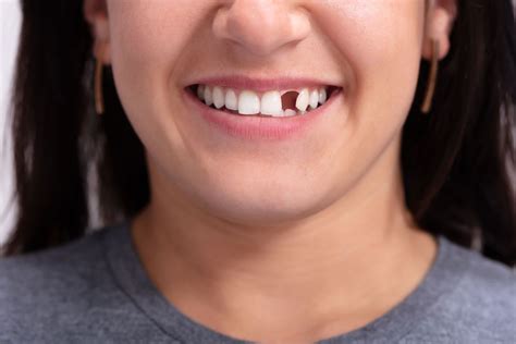 Sonhar Com Dente Caindo E Quebrado - Sonhar com dente quebrando é um sinal? Desvende!