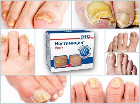 Грибок ногтя на большом пальце ноги: симптомы (ФОТО) и лечение ...