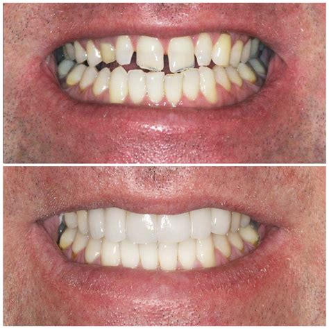 Teeth Veneers Before And After