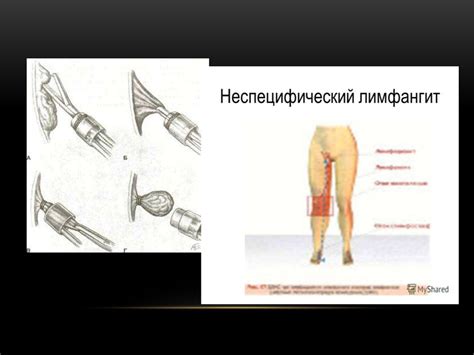 Іріңді паротит. Мастит. Парапроктит, лимфангаит, лимфаденит ...