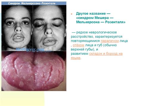 Невропатия лицевого нерва - презентация онлайн