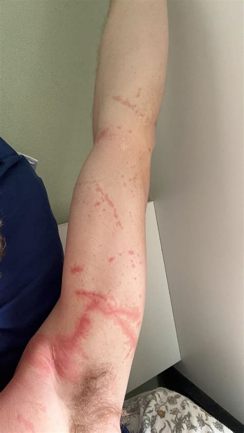 Man O War Jellyfish Sting Portuguese Men O' War Spotted On Local