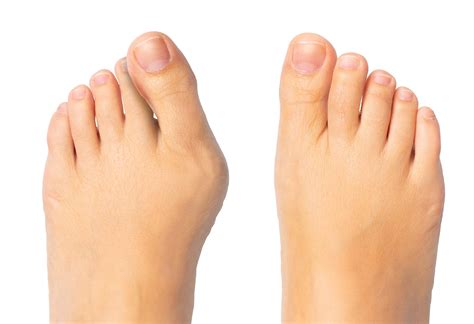 Just what exactly causes bunions? | Bunion Assassin