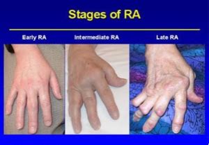 Rheumatoid Arthritis - Physiopedia