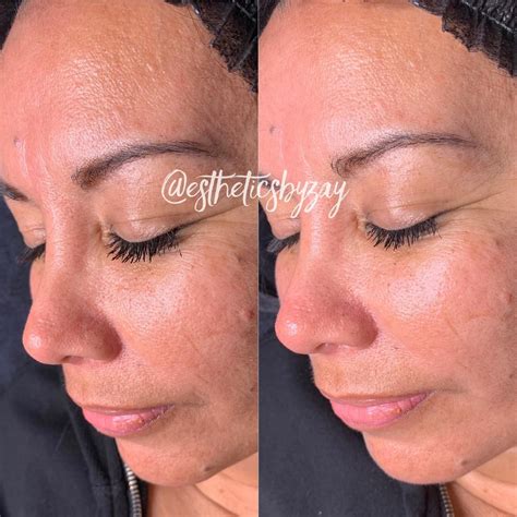 Albums 94+ Pictures Before And After Pictures Of Microdermabrasion Sharp