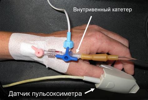 Постановка периферического венозного катетера. Внутривенное капельное ...