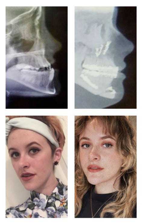 Swollen : jawsurgery