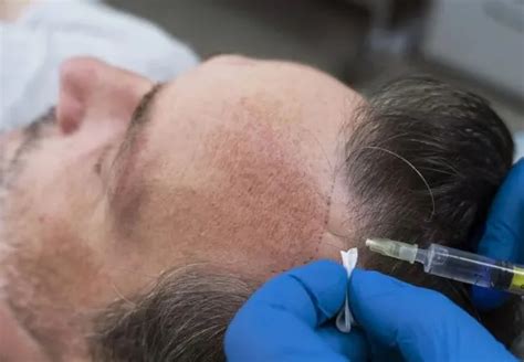Does a Hair Transplant Hurt and How to Treat? - Hair System