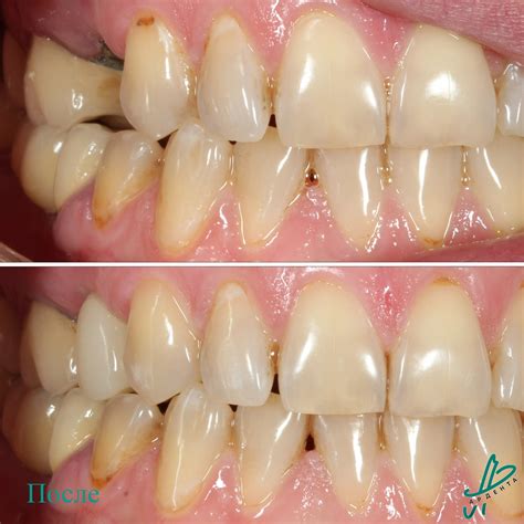 Импланты дентиум Dentium Superline в стоматологии Ардента в Ростове-на ...