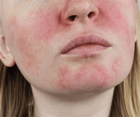rosacea montrose dermatology cosmetics