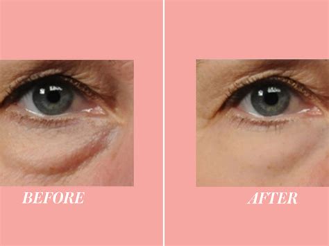 surgery bags under eyes 6