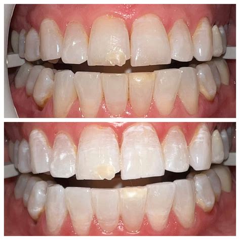 Before & After Dental Results at Relax Dental, Burlington NC