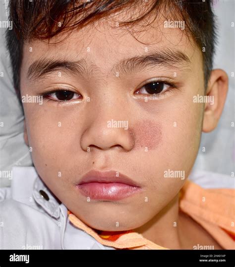 Ringworm infection on the face hi-res stock photography and images - Alamy