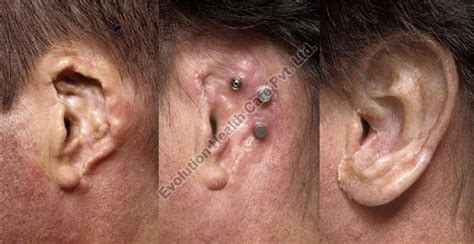 silicone ear prosthesis manufacturer supplier  surat india