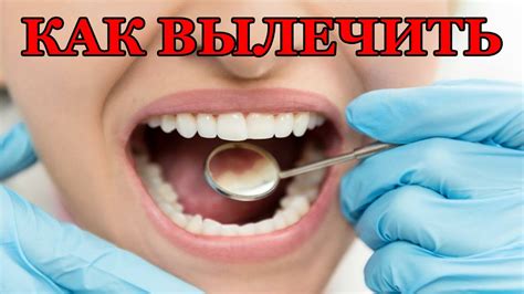 Лечение КАРИЕСА в Домашних УСЛОВИЯХ! Как ЛЕЧИТЬ Кариес НАРОДНЫМИ ...
