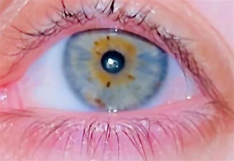 Central Heterochromia vs Hazel UPDATED with close-up flash : r/eyes