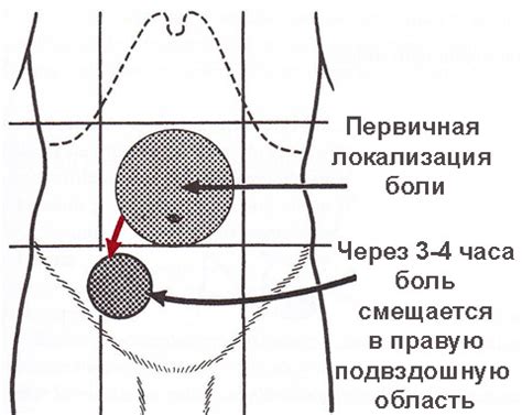 Как определить аппендицит в домашних условиях: 7 первых симптомов ...