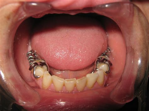 Types Of Clasps In Removable Partial Denture at Sara Miller blog