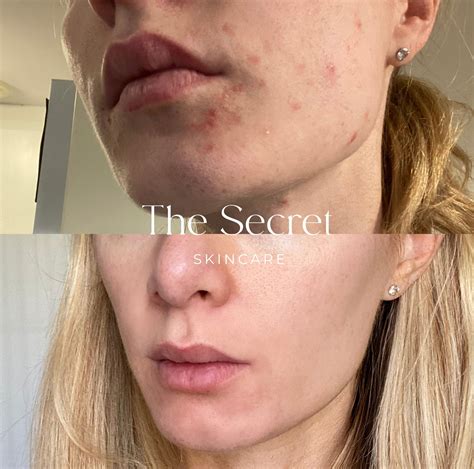 Our patient Jessica targets acne and... - The Secret Skincare