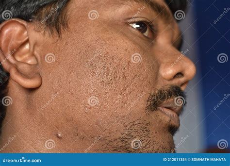 close   pimples marks  mans face deep acne scars   cheek