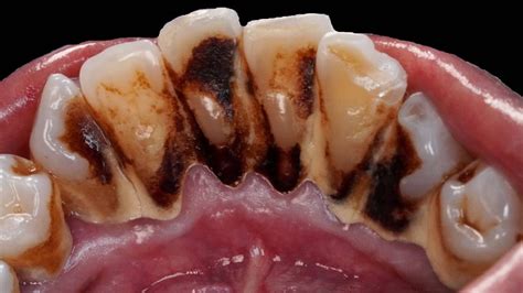 gigi perokok berat bisa rusak  merokok  buktinya joy dental