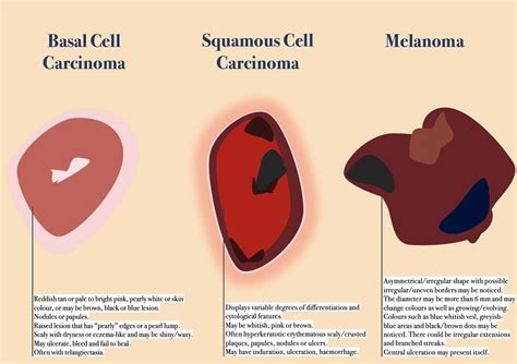 Main Type of Skin Cancer — Their Differences, Histology and Prevention ...