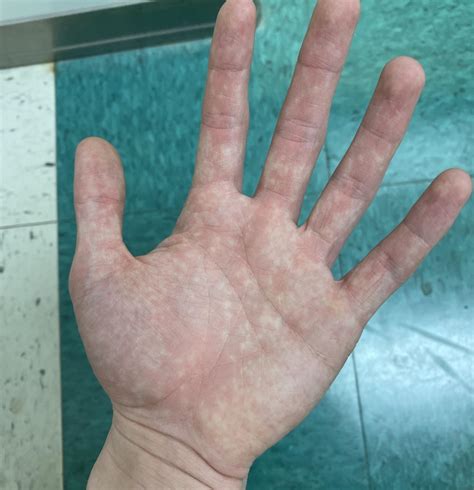 Why Do My Hands Get Itchy When Hot at Virginia Corns blog