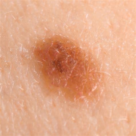 Junctional Melanocytic Nevus