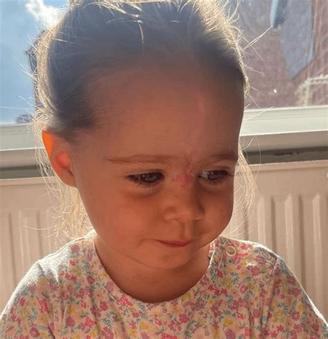 Because Their Daughter Was Born With A Huge Birthmark On Her Face, The ...