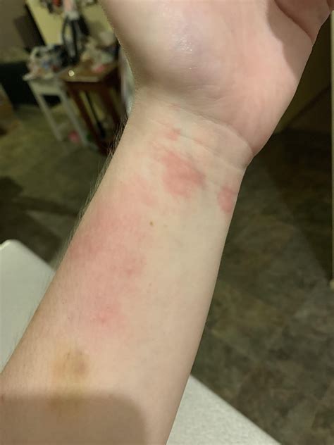 Does this look like an allergy to rat pee or the rats themselves?? : r/rat
