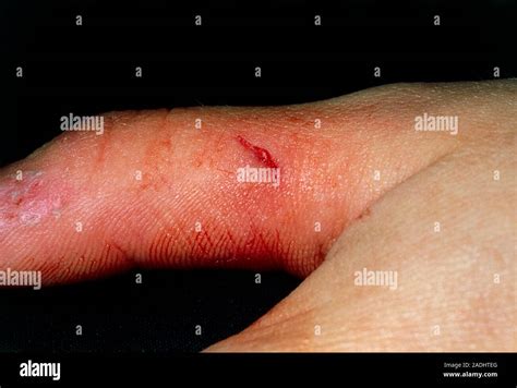 rabbit bite close    bite caused   pet rabbit   finger